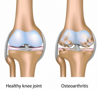 Cureus, A Novel Knee Traction Technique to Treat Chronic Knee Pain